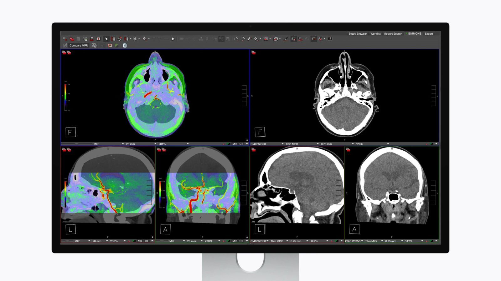Apple Studio Display XDR : l'écran qui veut séduire les radiologues