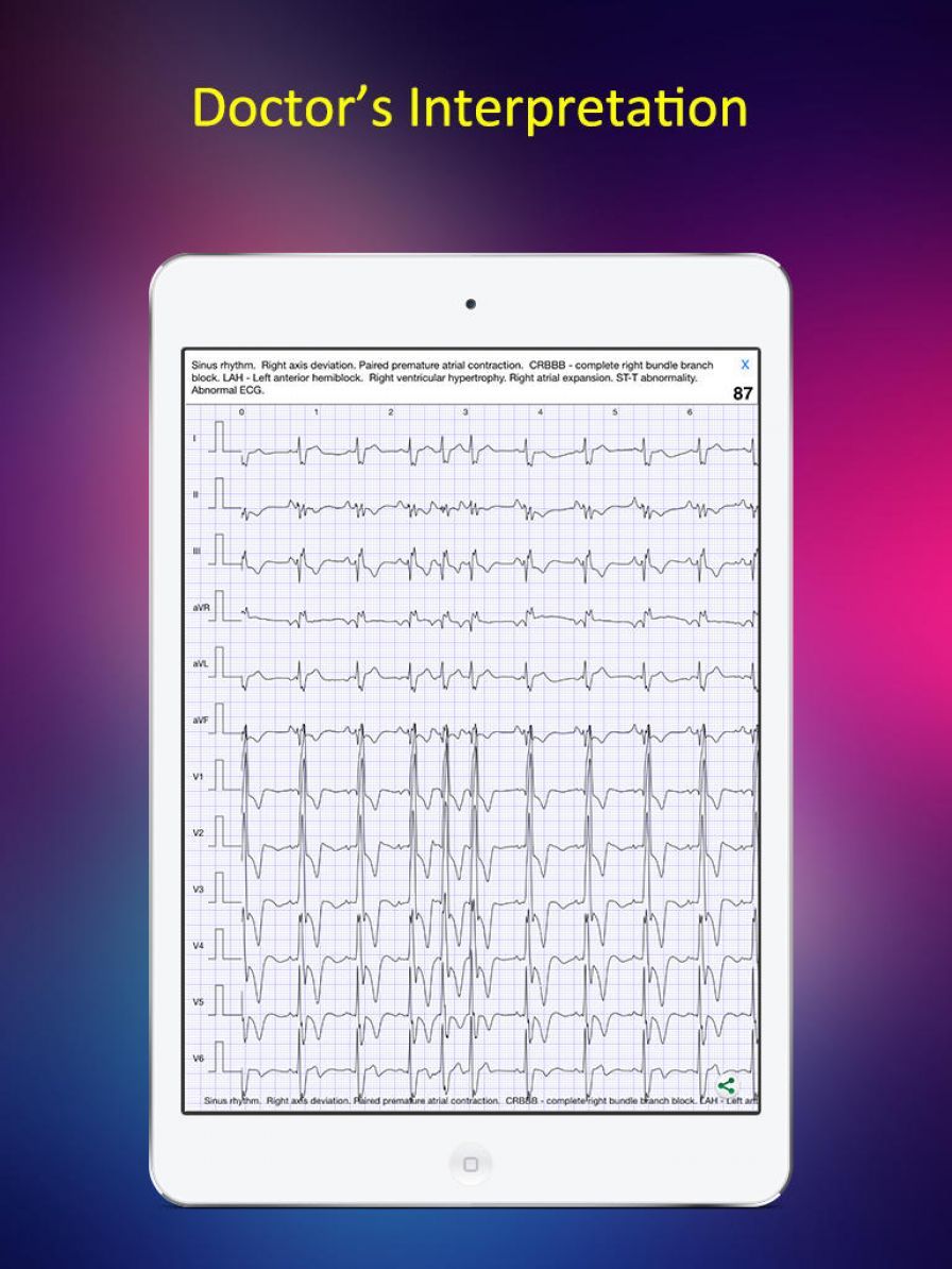 afib-lib-atrial-fibrillation-c ipa afib-lib-atrial-fibrillation-c ipa